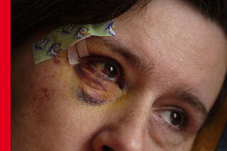 Frauengesicht mit verletztem Auge